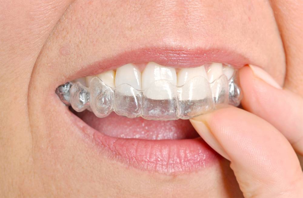 Denti: apparecchio invisibile. Per cosa si usa, benefici e consigli